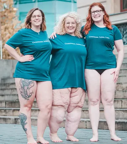 Lipoedème femme