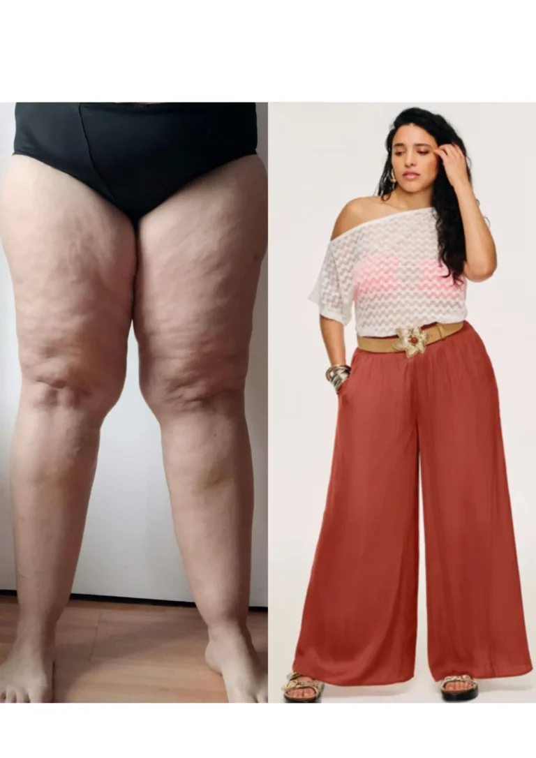 Image montrant les jambes d'une personne atteinte de lipoedème, accompagnée d'une autre image d'une femme portant un pantalon large et coloré.