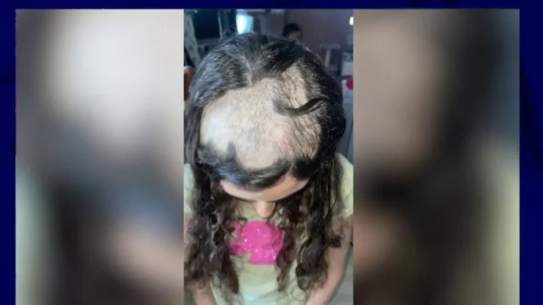 Camelia victime de trichotillomanie